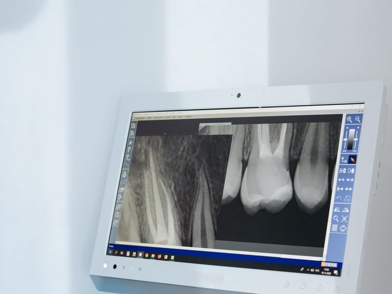 Digital dental X-ray on a monitor